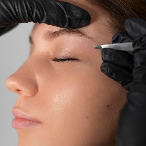 Microneedling